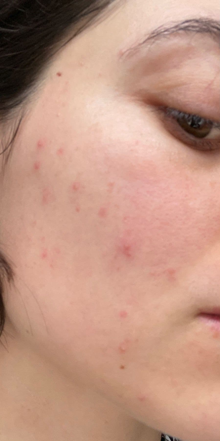 Oily, blemish-prone skin with visible pores before treatment